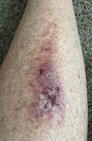 Robin claims that she suffered 18 burns and they are still not fully healed, leaving her vulnerable to infection