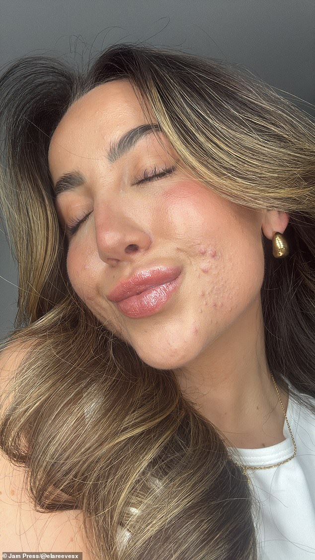 Ela Reeves, 25, from Essex, was struggling with a series of health conditions prior to the move, including chronic fatigue, sore joints and acne (pictured) when she lived in the UK