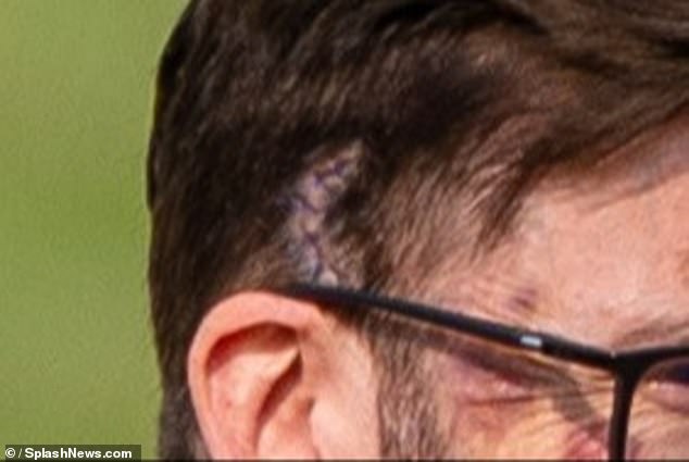 David was seen with a massive scar on the side of his head - using SPX makeup - following the shock blow to head last series