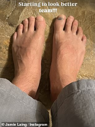 Jamie shared with his 1.5million followers that the swelling of his feet is slowly going down
