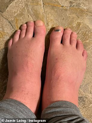 Jamie treated fans to a series of foot pictures as he recovered following the ultra marathon