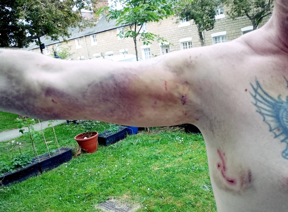 Man's injured ear after dog attack.