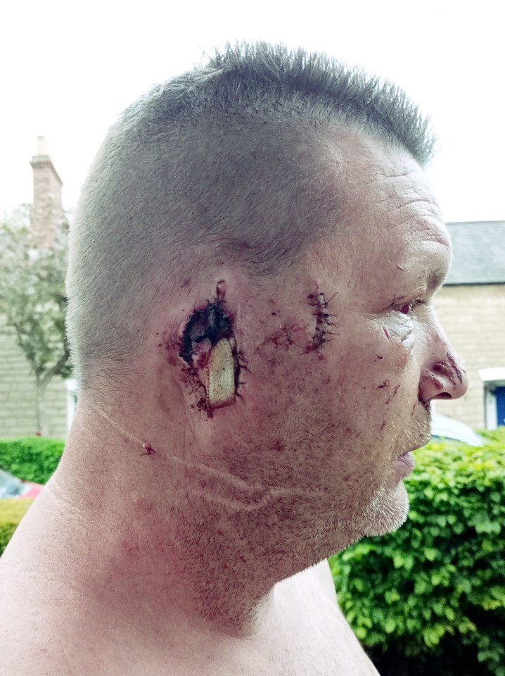 Man's ear bitten off by dog; injuries to face and head.