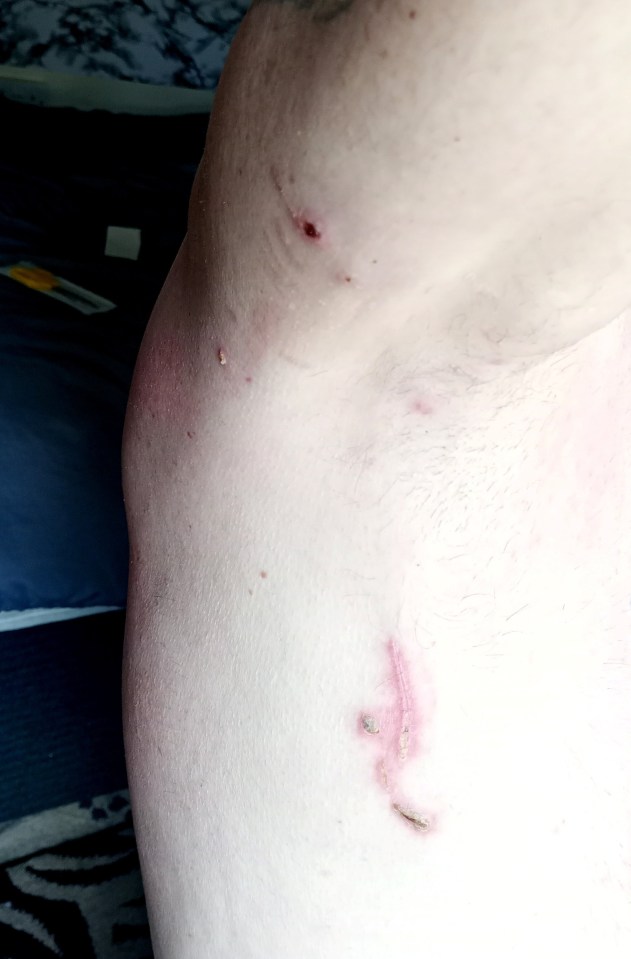 Dog bite injuries on a person's torso.
