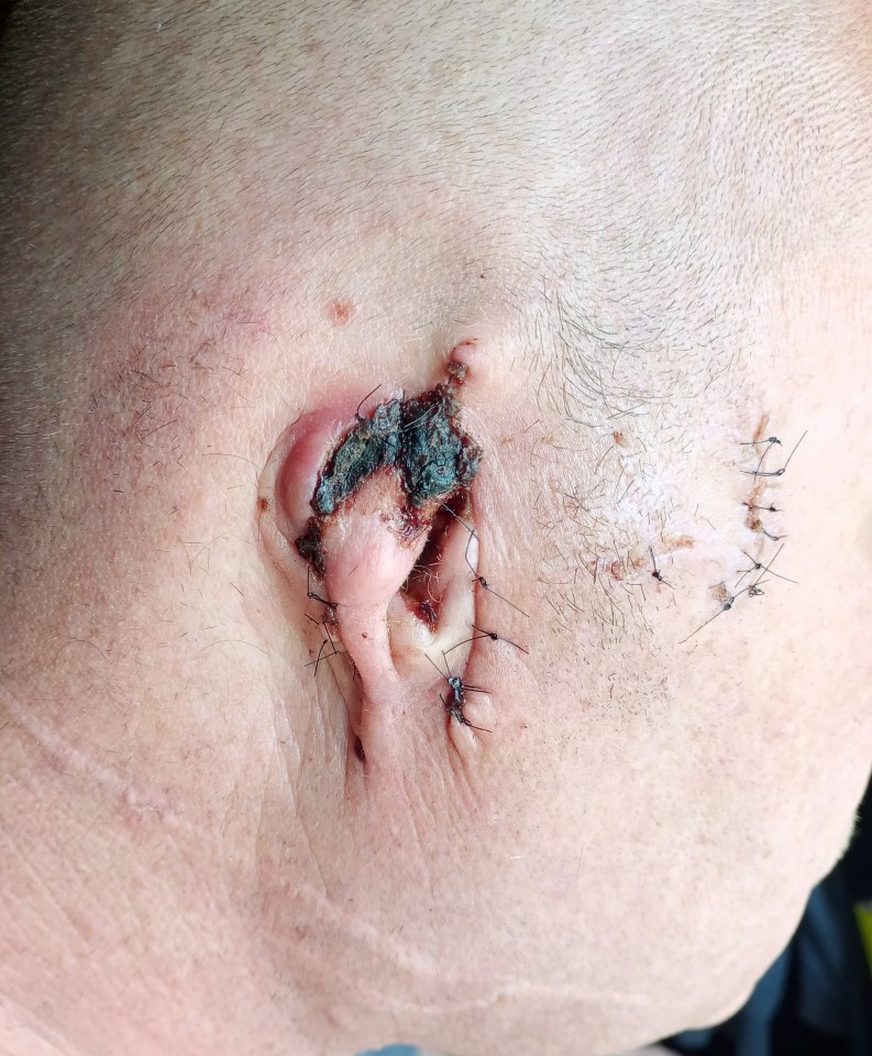 Close-up of a man's ear after a dog bite, showing severe damage and stitches.