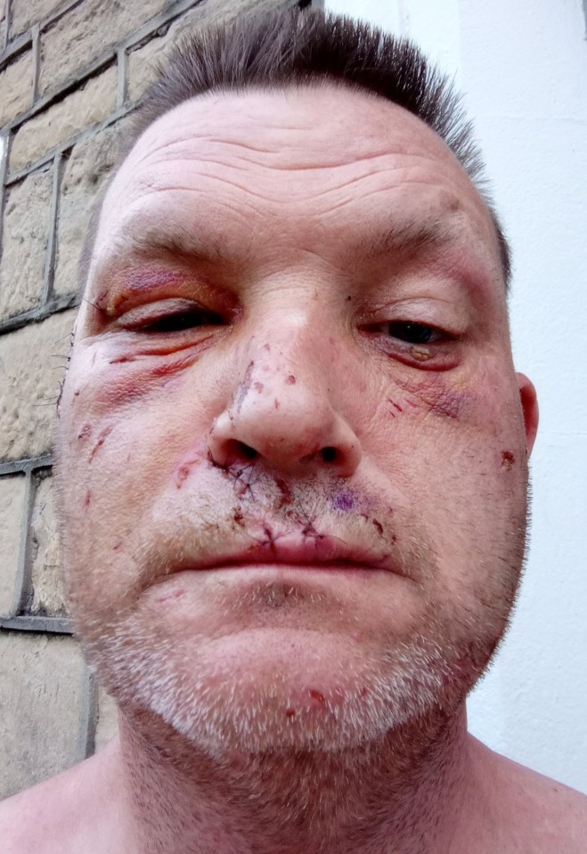 Close-up of a man's face showing severe injuries, including a missing ear.