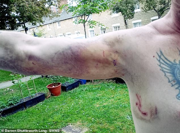 Mr Shuttleworth-Long said he initially found the dog's jaw had locked while it was nestled in to his armpit but as he tried to move it, the dog broke free and started to attack him