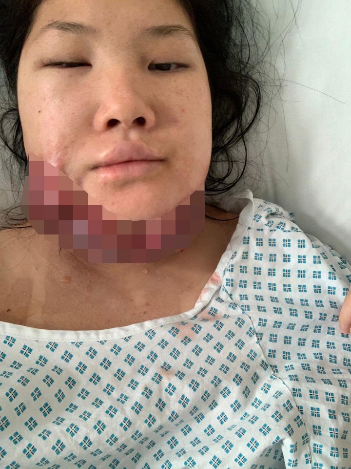 Close-up photo of a woman's face and neck with keloid scars from a fire dancing accident.