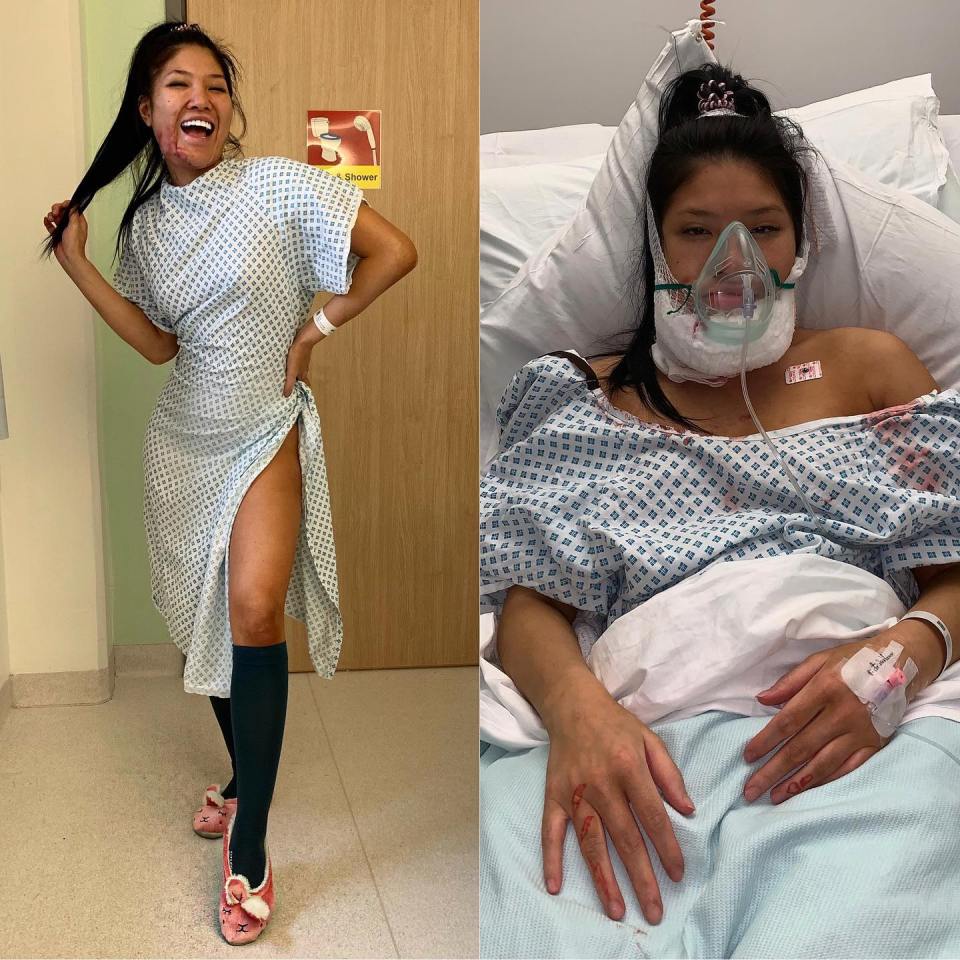 Diptych showing a motivational speaker before and after surgery.