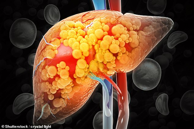 The build-up of dangerous fat in the organ is usually triggered by an unhealthy diet and sedentary lifestyle. Pictured: File photo