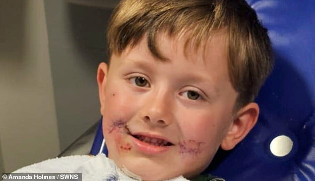 He was blue-lighted to hospital and needed a three hour operation to have his face stitched back together