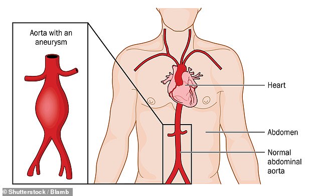 The thumb test will indicate if a person is harbouring an aortic aneurysm ¿ an abnormal bulge in the wall of the major blood vessel that can prove fatal if undetected