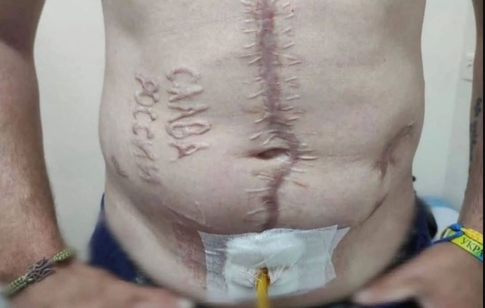A Ukrainian soldier's torso showing scars and the words "Glory to Russia" cut into his skin.