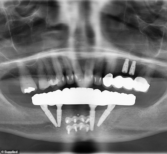 Another dental practice confirmed Annette's treatment had been mishandled and that Dr Hurst had used low-quality materials from overseas. (Pictured: a scan of her botched dental work)