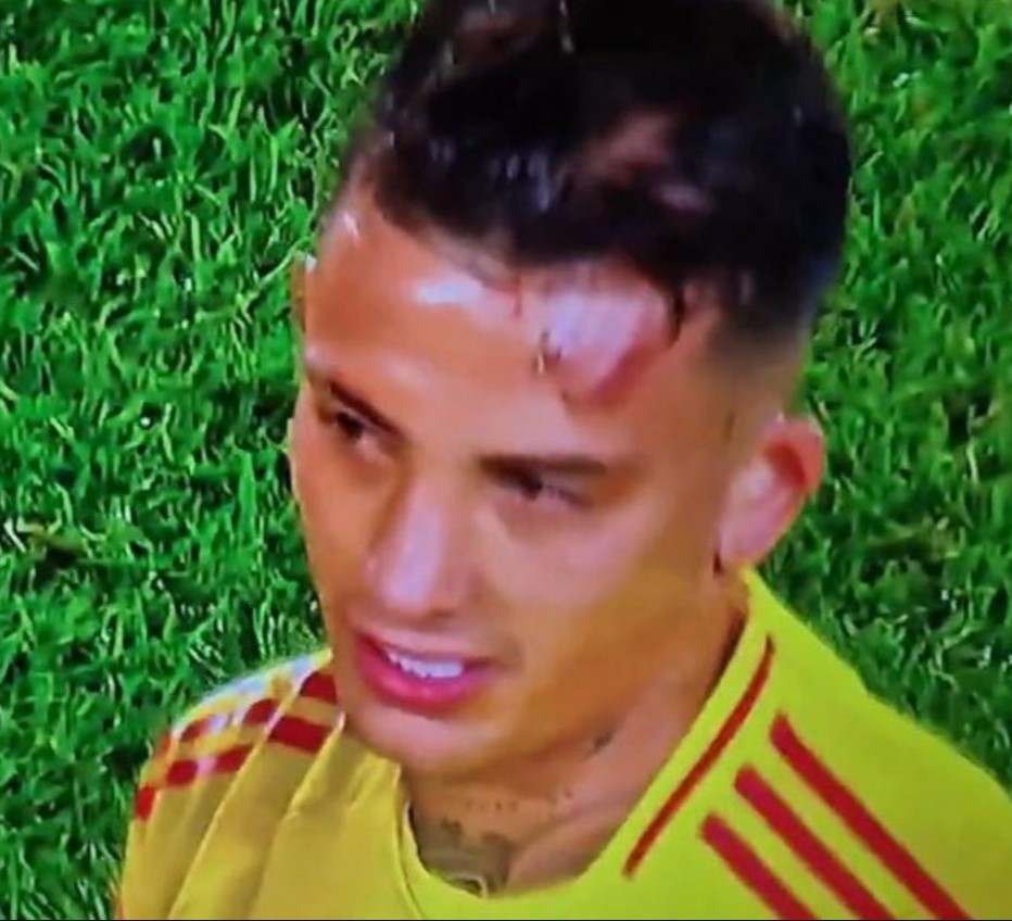 Soccer player with head wound.