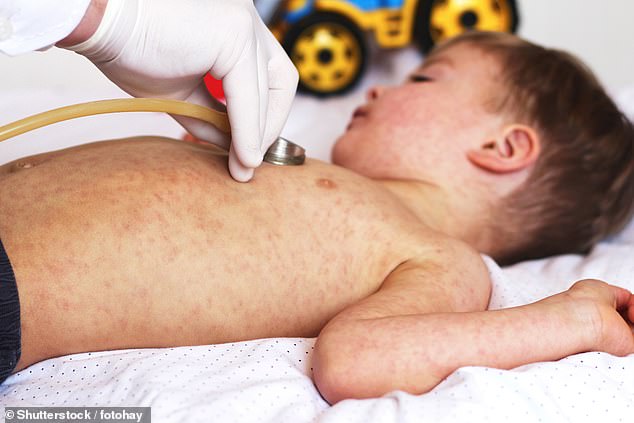 As well as being potentially fatal, measles, which commonly results in an all-over rash (pictured), can cause permanent deafness and mental impairment