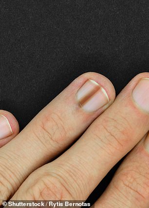 Dark nail stripes, like this one pictured on a finger nail, could signal a type of skin cancer