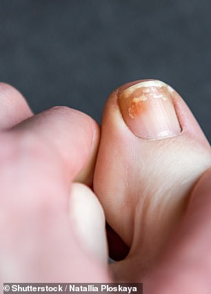 Yellow discolouration, pictured here, could indicate a toenail infection
