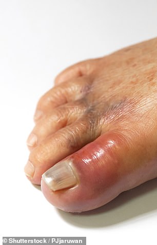 Swollen toes could indicate gout, which is more likely to occur in people who are overweight