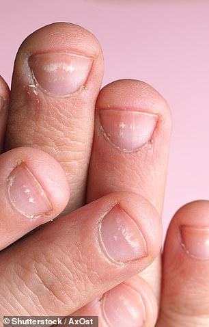 White spots on the nails can be caused by a deficiency of protein, zinc or iron