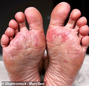 Athletes Foot is a common fungal infection that shows as itchy white patches between your toes