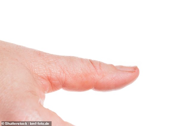 If nails change shape or look curved and 'spoon'-like it could indicate an iron deficiency or aneamia, the doctor said