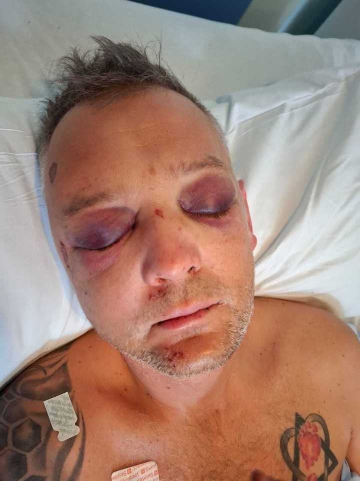 Man with severe facial injuries lying in a hospital bed.
