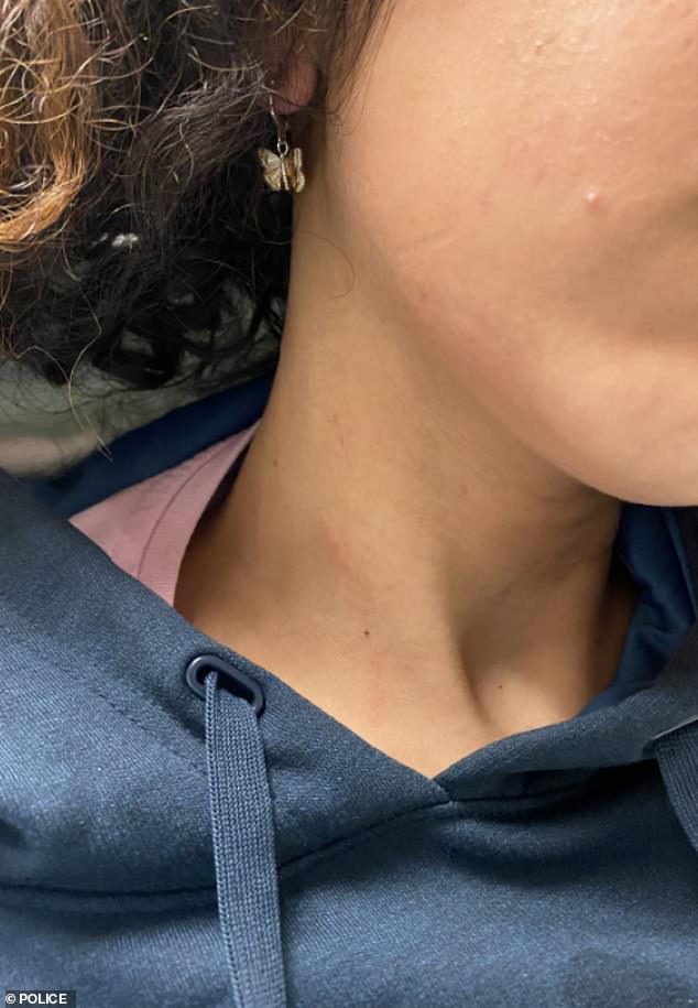 These are some of the cuts, welts, and broken bones the teenage girl suffered when her parents allegedly tried to strangle her in an 'honor killing'
