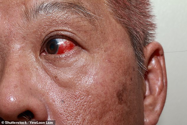 Diabetes and high blood pressure can damage blood vessels in the eyes and cause them to leak, turning them red (stock image)