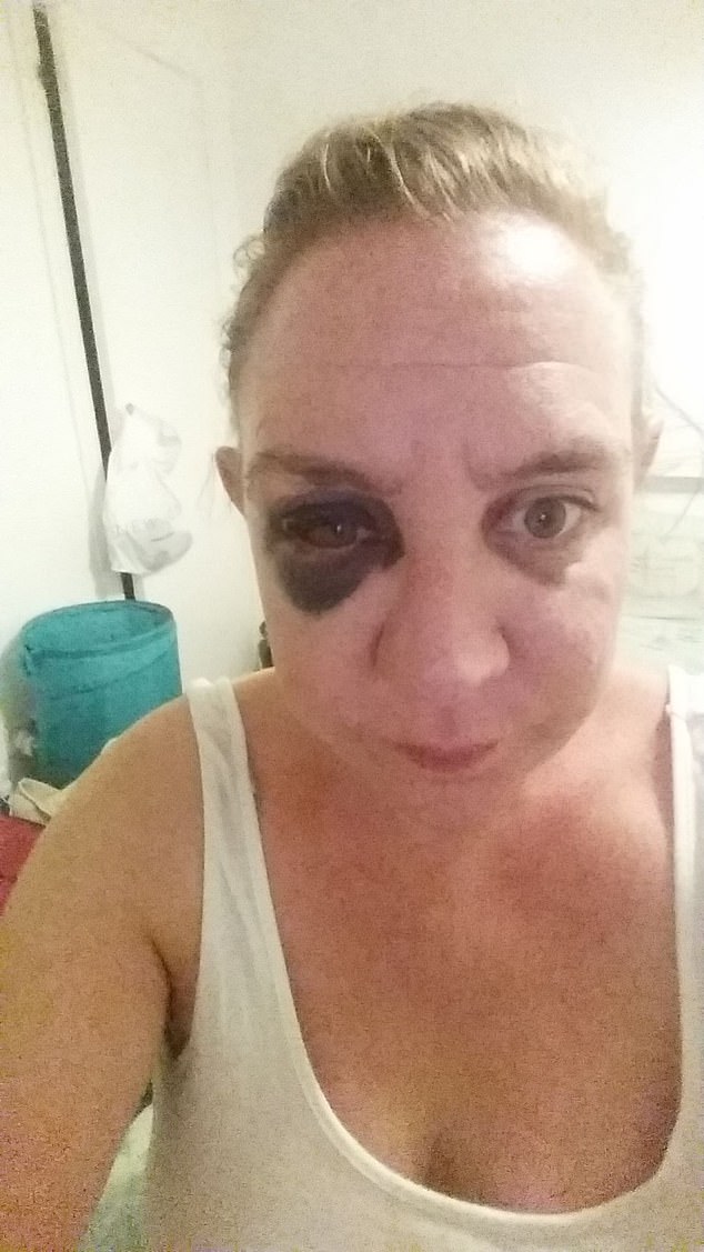 In 2019,  Amy  fractured my face after a fall while drunk and had to go onto antibiotics