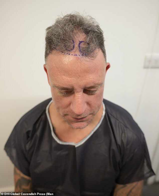 Speaking about having it done, he said: 'It's like I have got a full head of hair again and the transformation is pretty unbelievable' (pictured before)