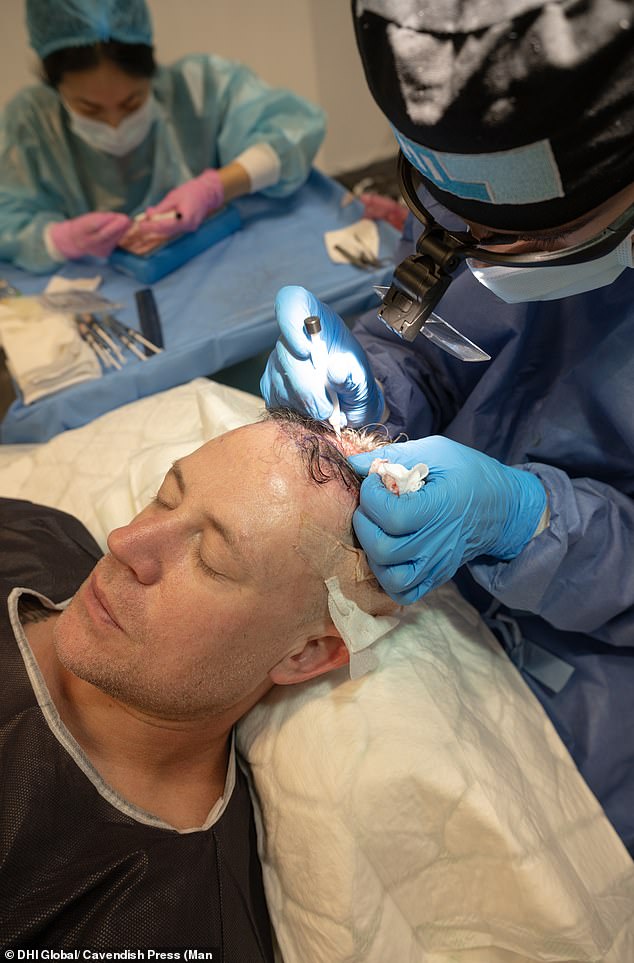 Wayne had been losing his hair right across his scalp for around ten years and by the time of his transplant last September he said that the cover was sparse