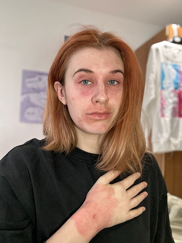 The eczma first presented itself when Katie was a teenager