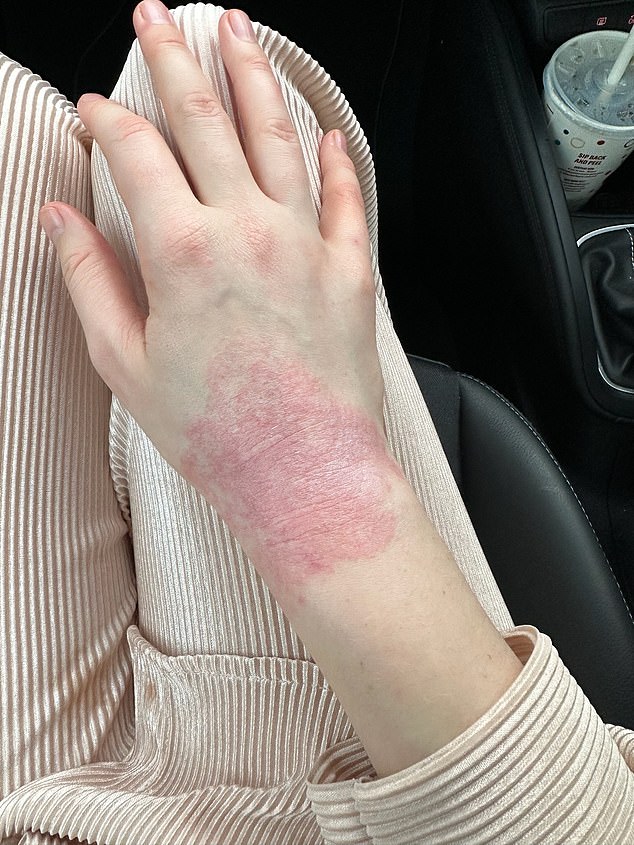 The eczma on Katie's hands is is known as pompholyx dyshidrotic - characterised by intensely itchy, watery blisters.