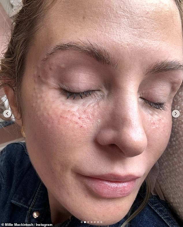 She added that she gets Botox done three times a year and also showed herself undergoing two polynucleotides treatments - referred to as salmon sperm injections - under her eyes and in her scalp