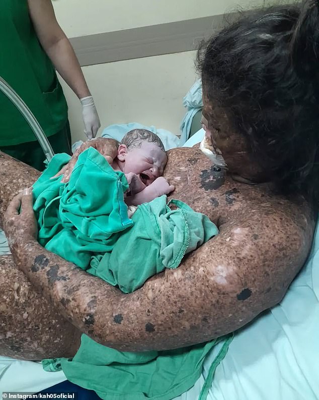 The 34-year-old mum has a rare skin condition that makes her extremely sensitive to sunlight and gives her an increased risk of melanoma