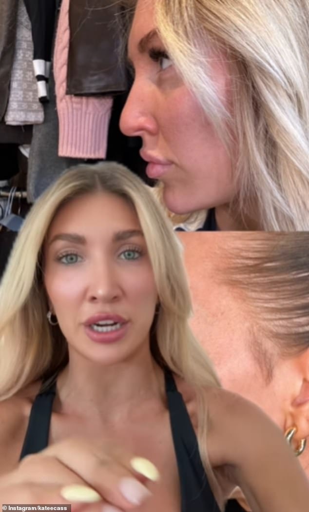 Kate also revealed that she got a nose job, sharing photographs of her side-on profile showing the difference in her face before and after the operation