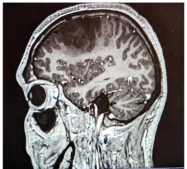 He did not expect the discovery of a 'pear-sized' low-grade glioma quietly growing in his head