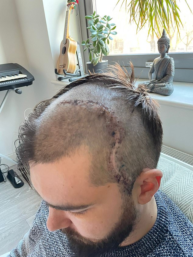 Medics diagnosed Connor with aphasia, a condition which restricts his verbal and gesturing abilities and affected him for almost three months after the surgery where he was unable to speak