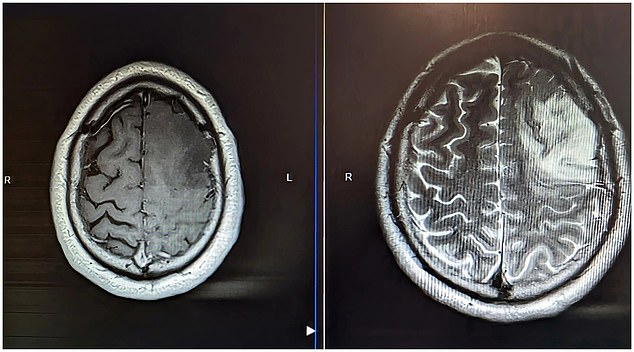 In February 2023 Connor underwent a craniotomy which he dipped in and out of consciousness during, and saw surgeons remove 70 per cent of the tumour