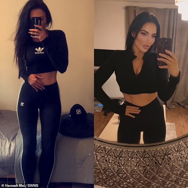 After she was taken off steroid medication, Hannah was determined to shed the weight she had gained due to the condition and does pilates everyday