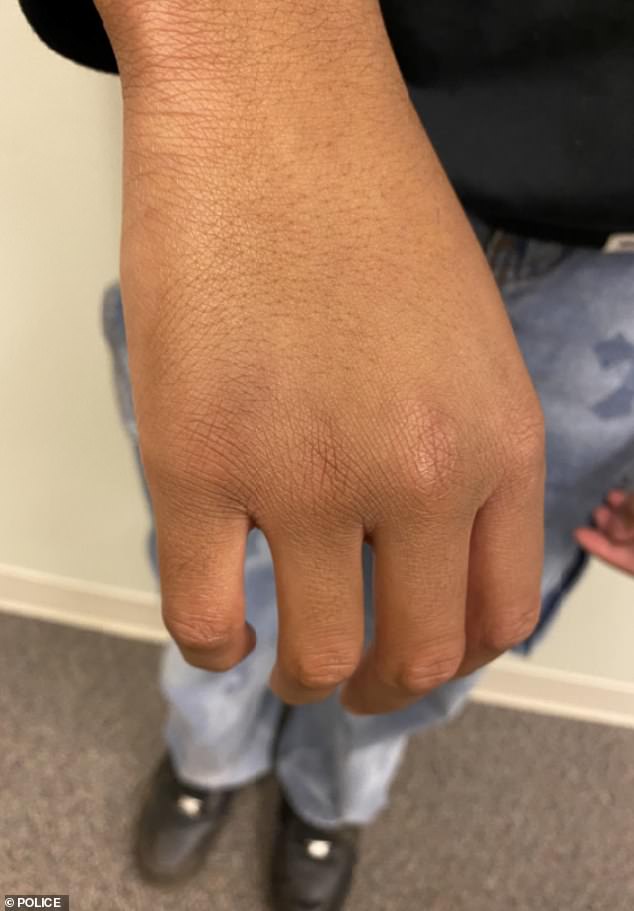 He suffered a boxer's fracture as he tried to get Ishan off his girlfriend, which is now in a cast, and was evident in the photos taken by police