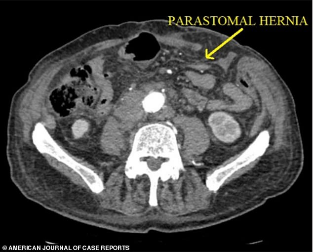 Pictured above is a CT scan of the man's hernia taken one month before is spontaneously exploded