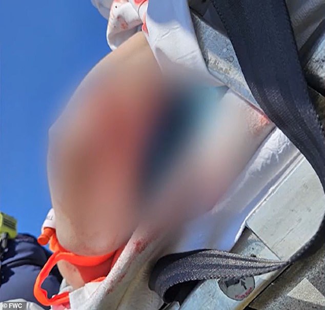 At the time of the attack, doctors weren't sure if her arm could be saved but eventually determined it would not need to be amputated