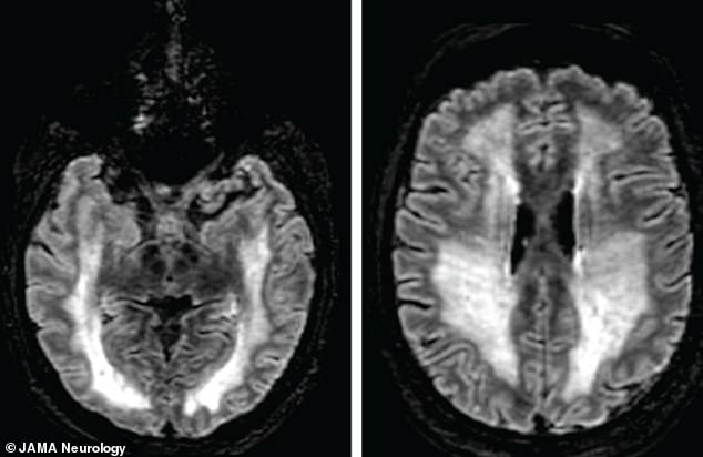 Brain scans revealed he was suffering from meningoencephalitis—a life threatening swelling of the brain and the tissue surrounding the brain and spinal cord—according to doctors who shared his tale in a medical journal