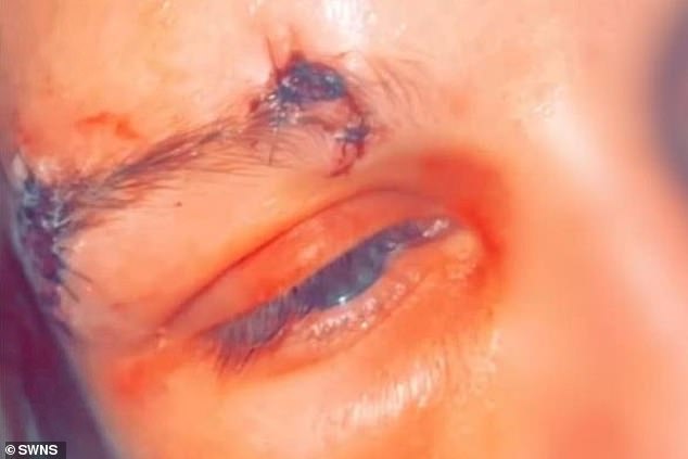 He tried to bite her eye out, but fortunately his teeth missed and instead he gouged out a chunk of her eyebrow