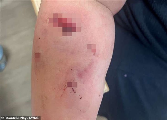 She had several X-rays to ensure the puncture had not hit her bone, before undergoing the reconstructive surgery (Pictured: Bunnie's injuries)