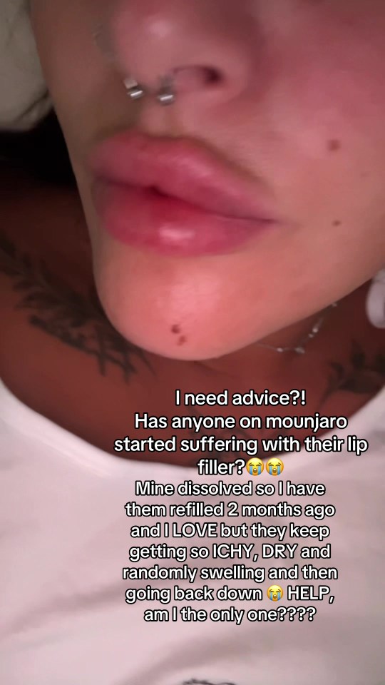 Close-up of a person's lips, which are swollen and itchy due to lip filler, seeking advice.