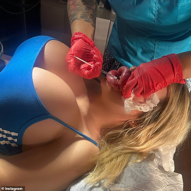 She got her very first filler at age 18 - as 'soon as she could legally' - and hasn't stopped since then