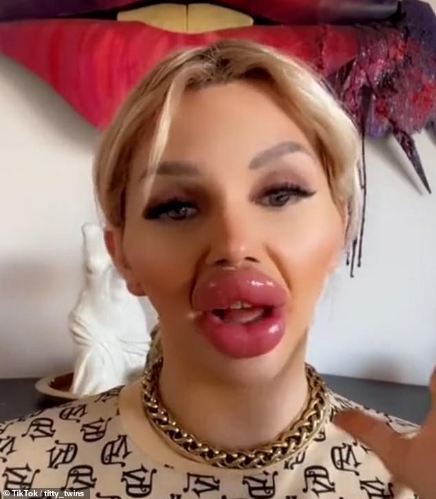 Vienna often shows off her enormous lips on social media, where she's unfortunately received a slew of hate over her abnormal look